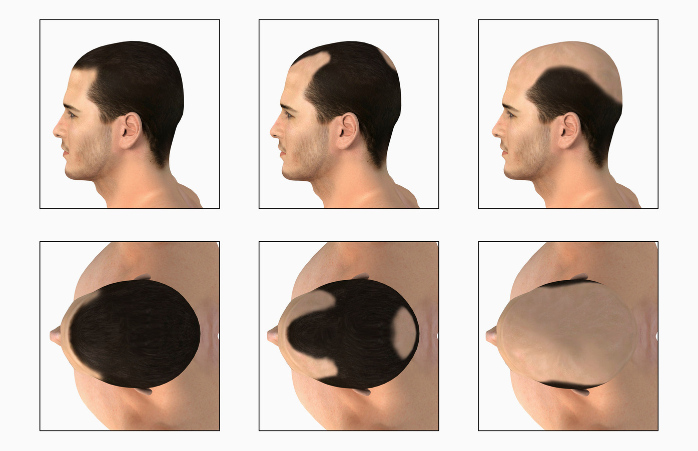 Illustration depicting the process of balding. A series of above and side views are shown.